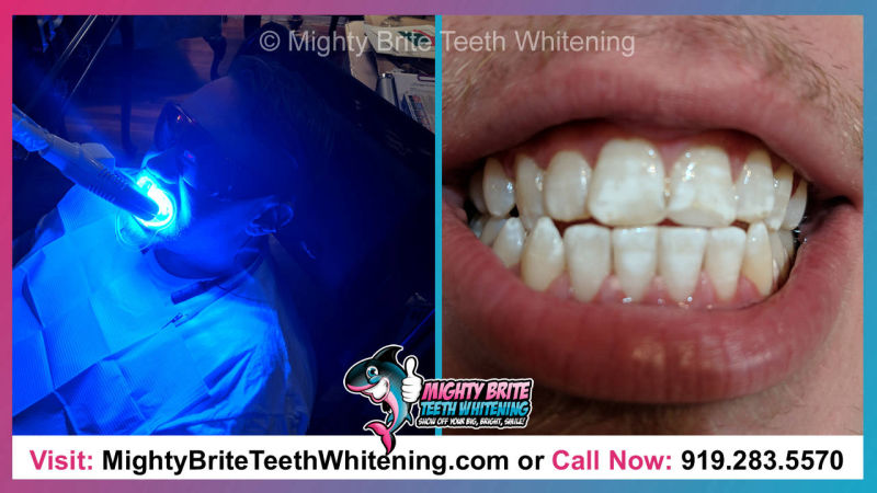 Top Teeth Whitening Service Raleigh Clayton NC