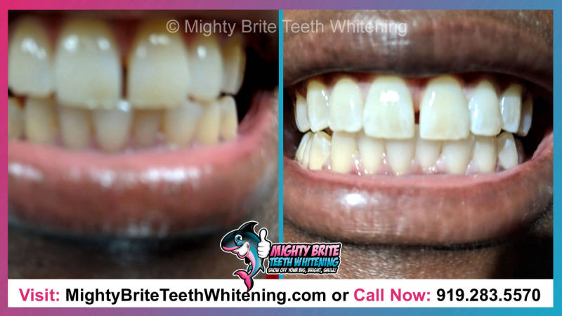 Teeth Whitening Deals Raleigh Clayton NC