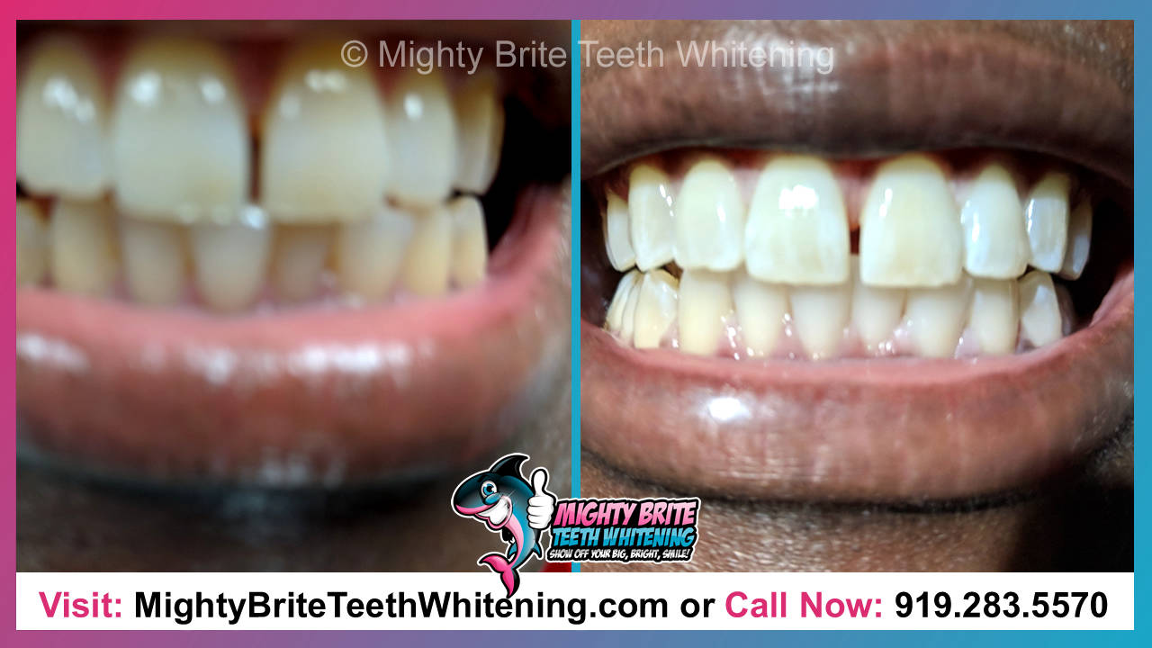 Teeth Whitening Deals Raleigh Clayton NC