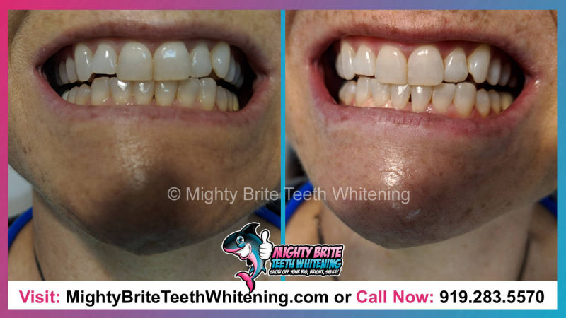 Cosmetic Teeth Bleaching Raleigh Clayton NC